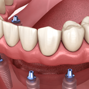 Cost-Effective Dentures