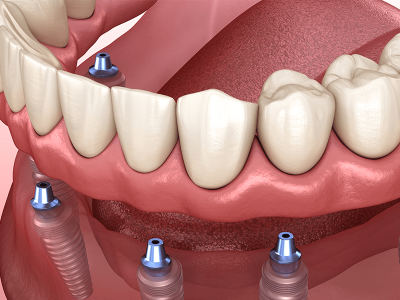 Cost-Effective Dentures