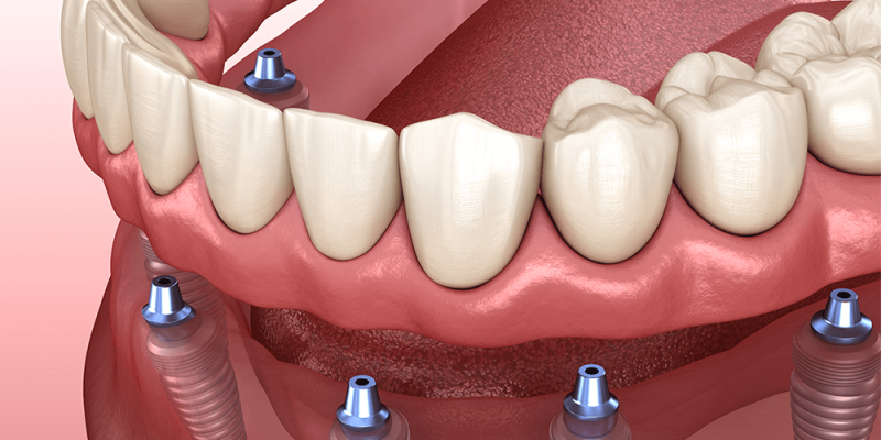 Cost-Effective Dentures